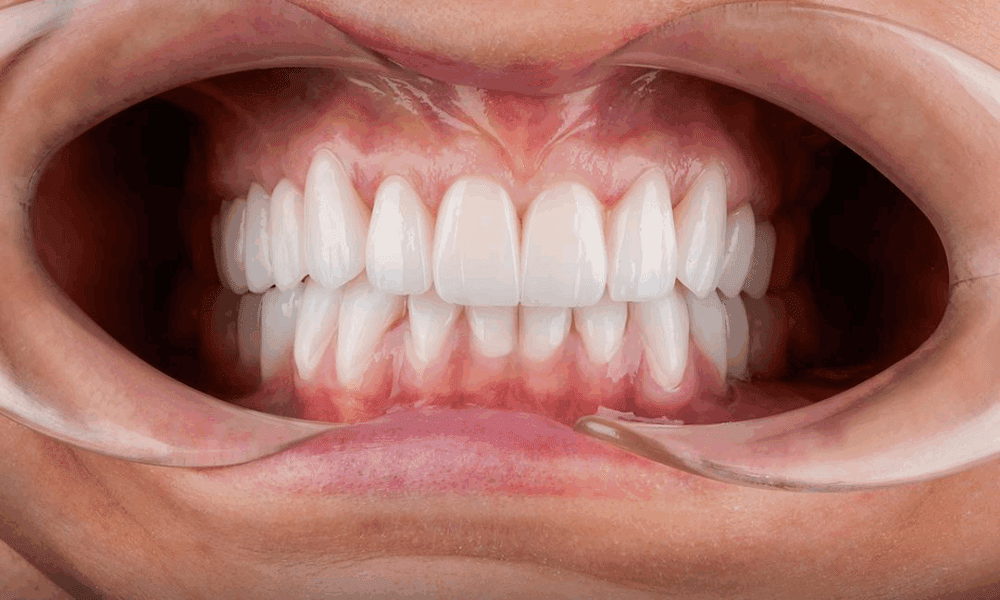 shocking-truth:-how-much-does-a-hollywood-smile-cost-in-2026?